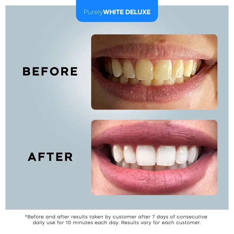 Purelywhite Teeth Whitening Kit | Advanced 10X LED Light, Instant Whitening, Stain Remover